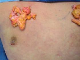 Gynecomastia Surgery Before & After Image