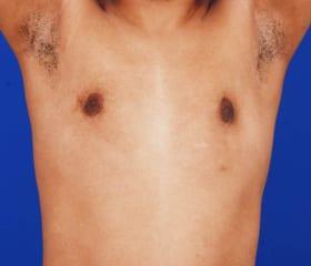 Gynecomastia Surgery Before & After Image