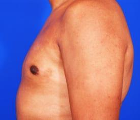 Gynecomastia Surgery Before & After Image