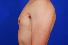 Gynecomastia Surgery Before & After Image