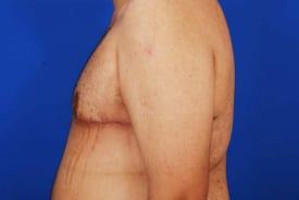 Gynecomastia Surgery Before & After Image