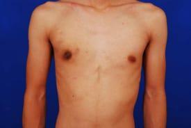Gynecomastia Surgery Before & After Image