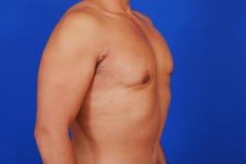 Gynecomastia Surgery Before & After Image