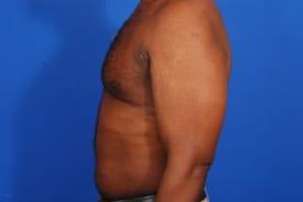 Gynecomastia Surgery Before & After Image