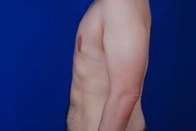 Gynecomastia Surgery Before & After Image