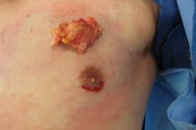 Gynecomastia Surgery Before & After Image