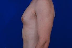 Gynecomastia Surgery Before & After Image