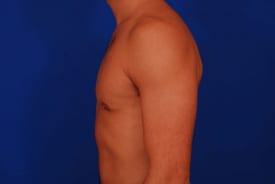 Gynecomastia Surgery Before & After Image