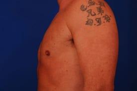 Gynecomastia Surgery Before & After Image