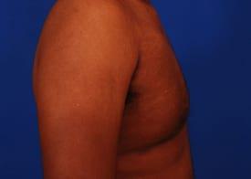 Gynecomastia Surgery Before & After Image