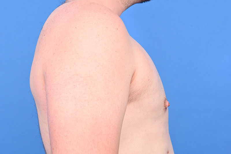 Gynecomastia Surgery Before & After Image