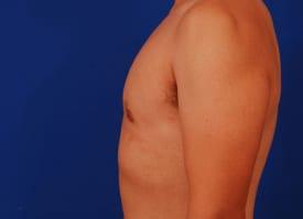 Gynecomastia Surgery Before & After Image