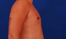 Gynecomastia Surgery Before & After Image