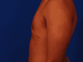Gynecomastia Surgery Before & After Image