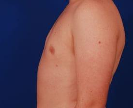 Gynecomastia Surgery Before & After Image