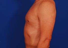 Gynecomastia Surgery Before & After Image