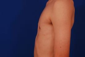 Gynecomastia Surgery Before & After Image