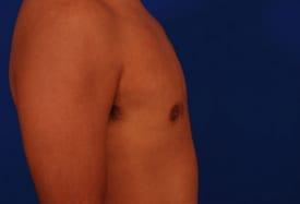 Gynecomastia Surgery Before & After Image