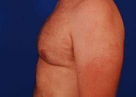 Gynecomastia Surgery Before & After Image