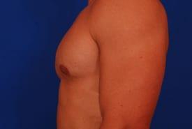 Gynecomastia Surgery Before & After Image
