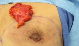 Gynecomastia Surgery Before & After Image