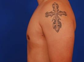 Gynecomastia Surgery Before & After Image