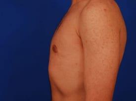 Gynecomastia Surgery Before & After Image