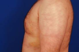 Gynecomastia Surgery Before & After Image