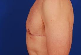 Gynecomastia Surgery Before & After Image