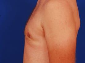Gynecomastia Surgery Before & After Image