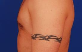 Gynecomastia Surgery Before & After Image