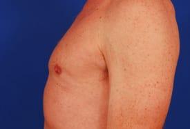 Gynecomastia Surgery Before & After Image