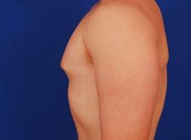 Gynecomastia Surgery Before & After Image
