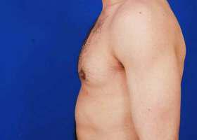 Gynecomastia Surgery Before & After Image