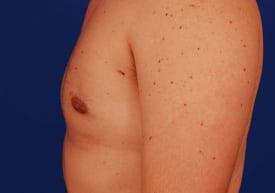 Gynecomastia Surgery Before & After Image