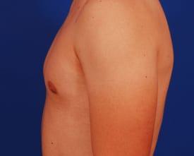 Gynecomastia Surgery Before & After Image