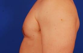 Gynecomastia Surgery Before & After Image