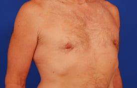 Gynecomastia Surgery Before & After Image