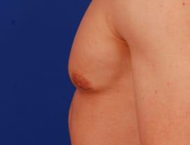 Gynecomastia Surgery Before & After Image