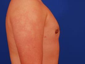 Gynecomastia Surgery Before & After Image