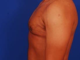 Gynecomastia Surgery Before & After Image
