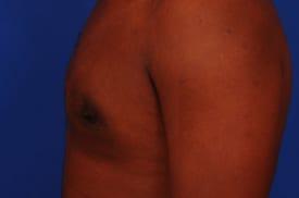 Gynecomastia Surgery Before & After Image