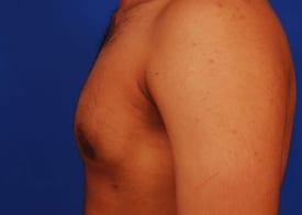 Gynecomastia Surgery Before & After Image