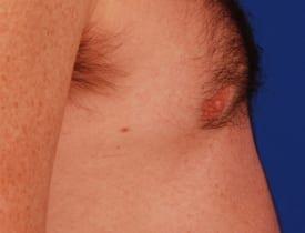 Gynecomastia Surgery Before & After Image