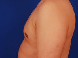 Gynecomastia Surgery Before & After Image