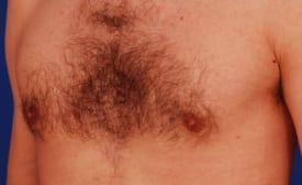 Gynecomastia Surgery Before & After Image