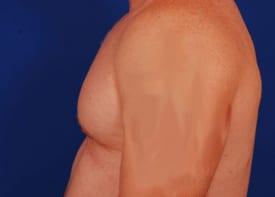 Gynecomastia Surgery Before & After Image