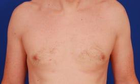 Gynecomastia Surgery Before & After Image