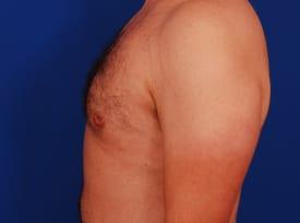 Gynecomastia Surgery Before & After Image