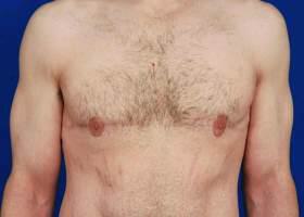 Gynecomastia Surgery Before & After Image